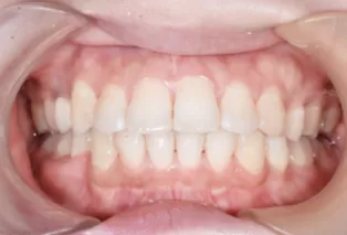 Intraoral photos after treatment