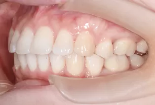 Intraoral photos after treatment