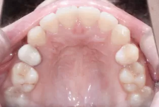 Intraoral photos after treatment