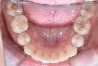 Intraoral photos after treatment