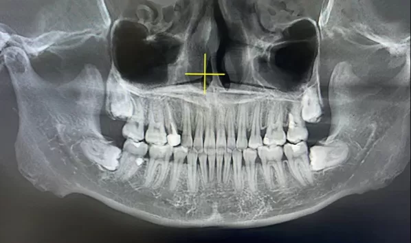 X-rays before treatment