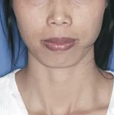 Facial photos before treatment