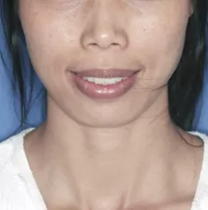 Facial photos before treatment