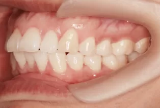 Intraoral photos