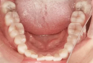 Intraoral photos