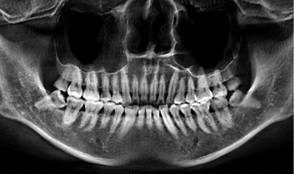 X-rays before treatment