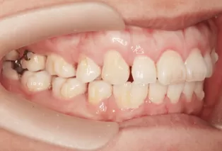 Intraoral photos