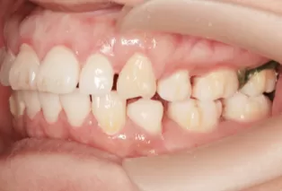 Intraoral photos