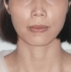 Facial photos before treatment