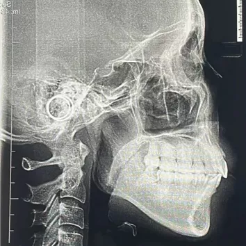 X-rays before treatment