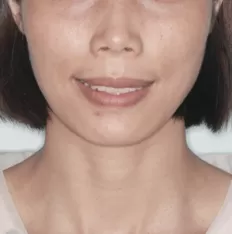 Facial photos before treatment