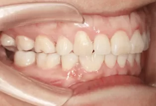 Intraoral photos after treatment