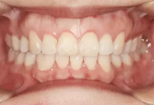 Intraoral photos after treatment