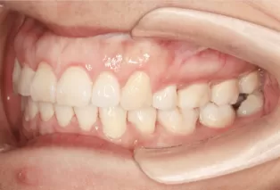 Intraoral photos after treatment