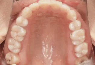 Intraoral photos after treatment