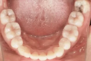 Intraoral photos after treatment