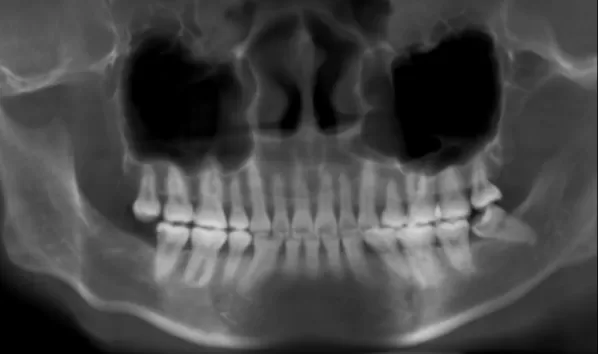 X-rays before treatment