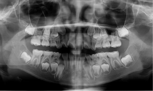 X-rays before treatment