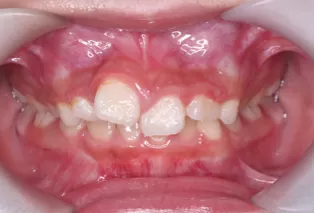 Intraoral photos