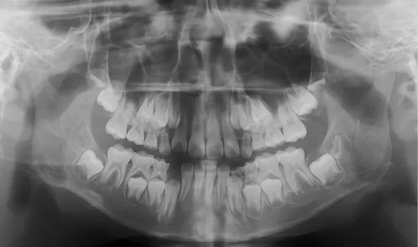 X-rays before treatment