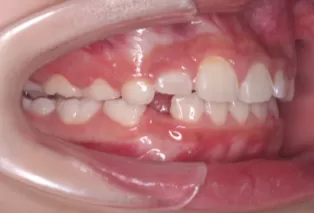 Intraoral photos after treatment