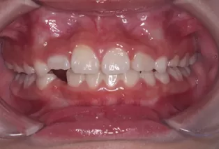 Intraoral photos after treatment