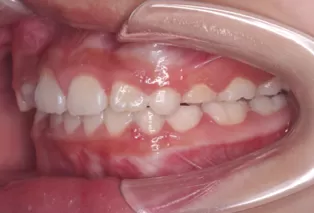 Intraoral photos after treatment