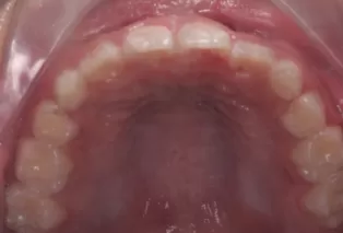 Intraoral photos after treatment