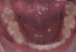 Intraoral photos after treatment