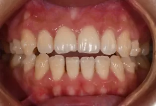 Intraoral photos