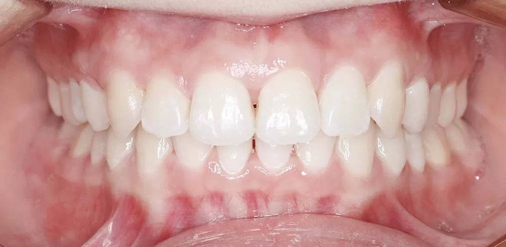 Deep Bite Molar Distalization