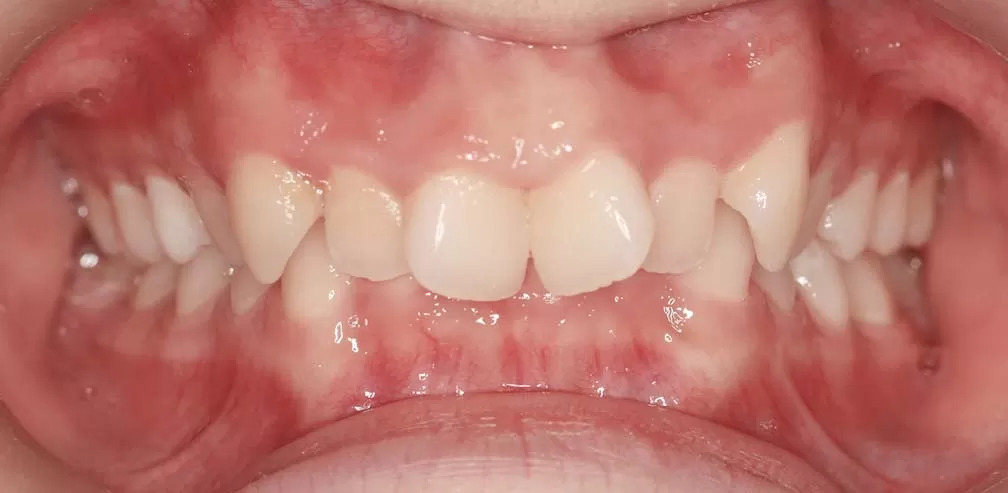 Deep Bite Molar Distalization