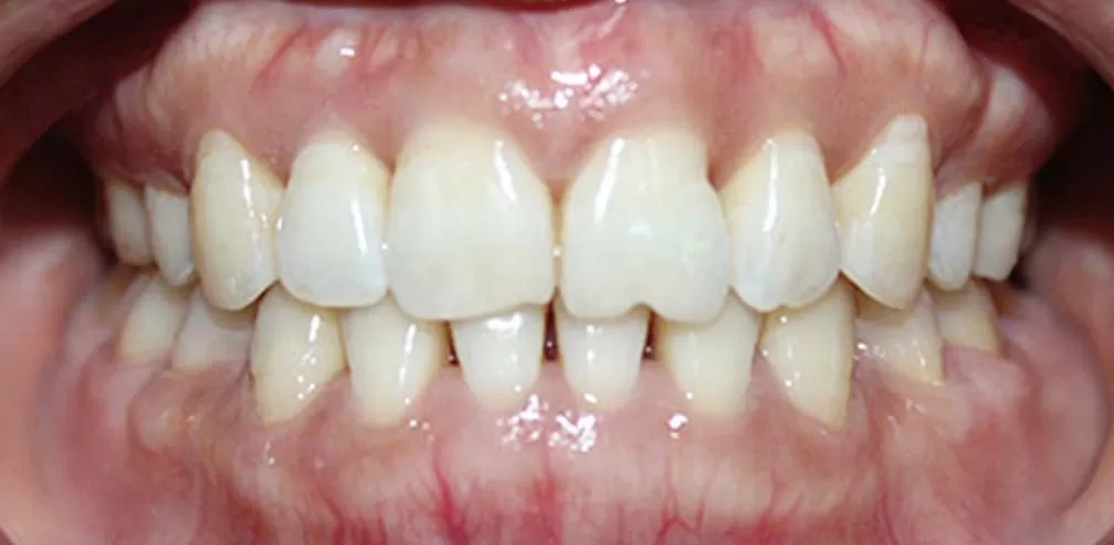 Premolar Extraction Crossbite of Individual Teeth