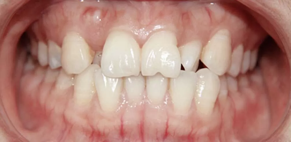 Premolar Extraction Crossbite of Individual Teeth