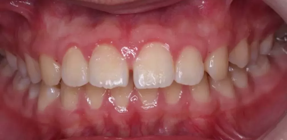 Smartee Teen-Facial Convexity-Mandibular Retrusion, 16 Years Old