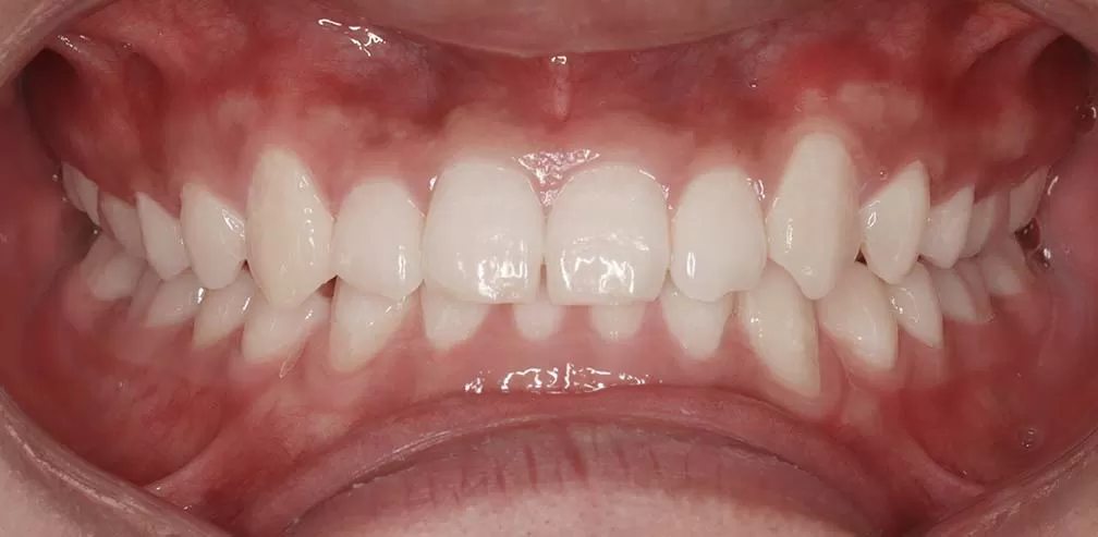 Anterior crossbite