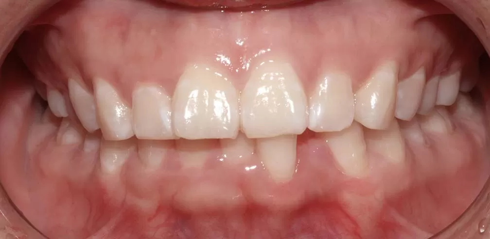 Deep Overbite and Overjet