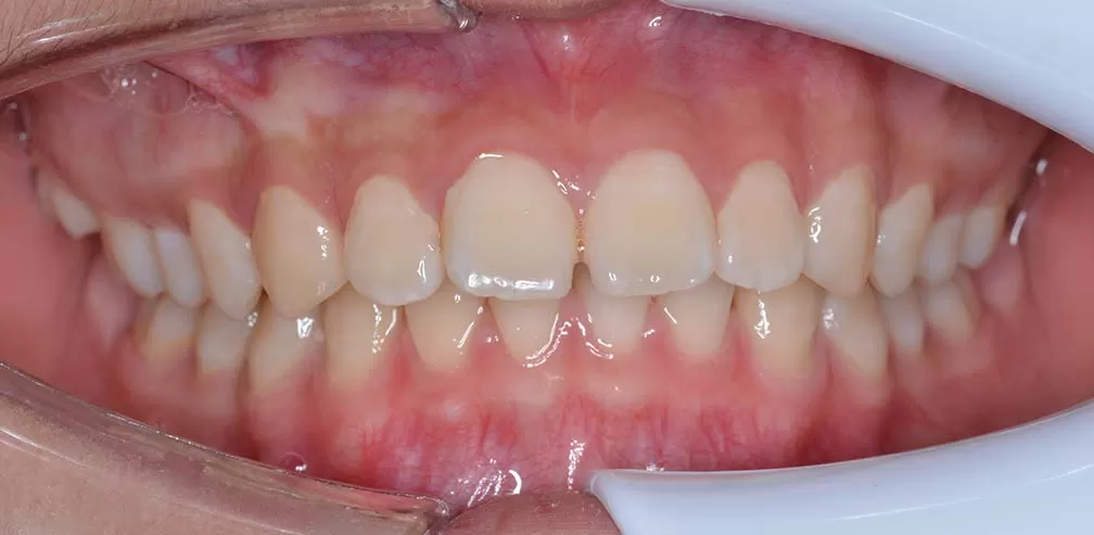 Deep Overjet Maxillary Distalization Mandibular Advancement