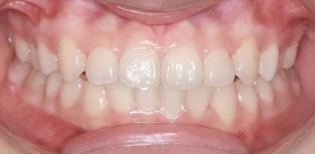 Deep Overbite with Anterior Teeth Retroclination