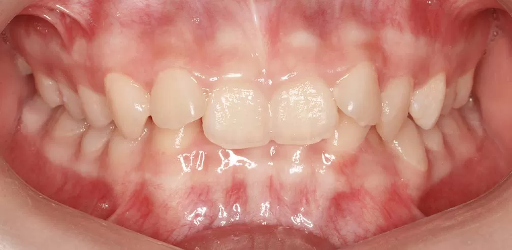 Deep Overbite with Anterior Teeth Retroclination