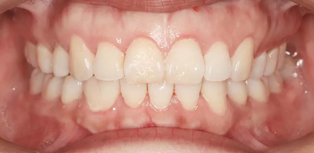 Anterior Teeth Protrusion