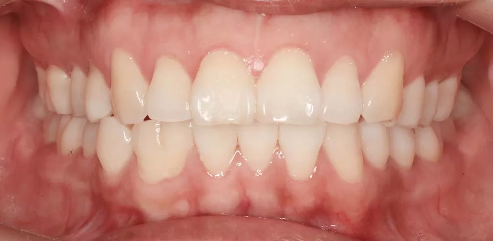 Anterior Teeth Protrusion