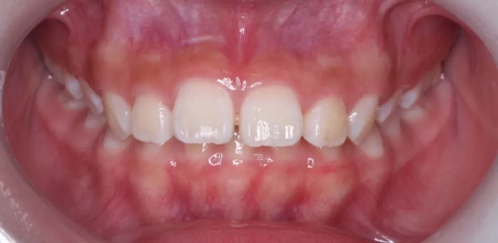 Smartee Teen-Facial Convexity- Mandibular Retrusion, 12 Years Old Female