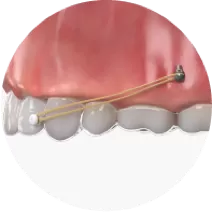 Traction between anterior and the implant screw